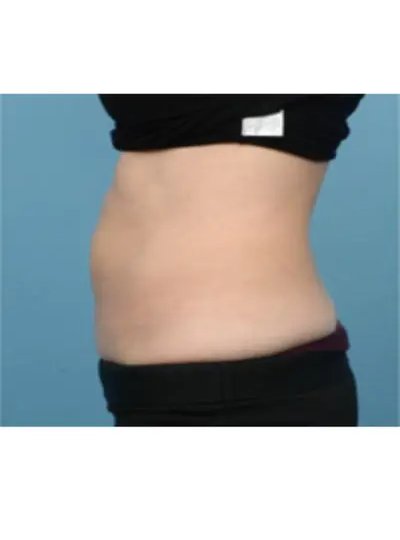 Cryolipolyse abdomen apres Activ Ice