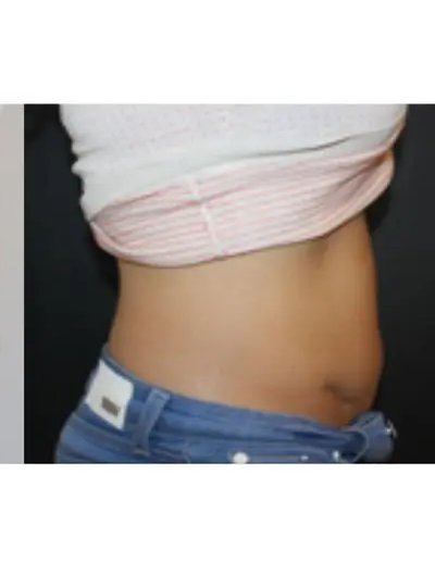 Apres cryolipolyse abdomen Activ Ice