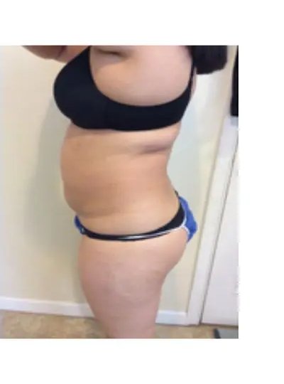 Apres cryolipolyse abdomen Activ Ice
