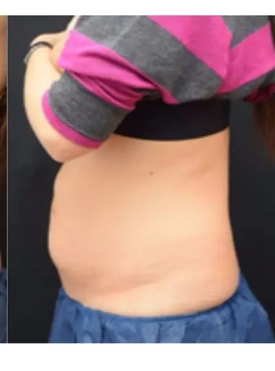 Apres cryolipolyse abdomen Activ Ice