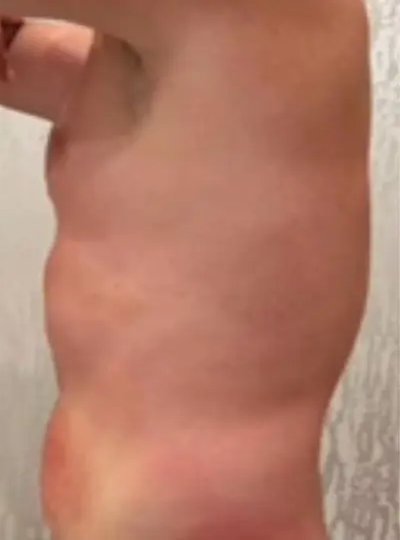 Apres cryolipolyse abdomen Activ Ice