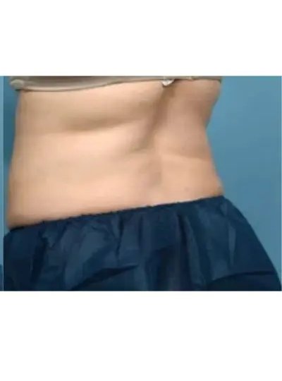 Apres cryolipolyse abdomen Activ Ice