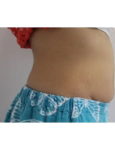 Avant cryolipolyse abdomen Activ Ice