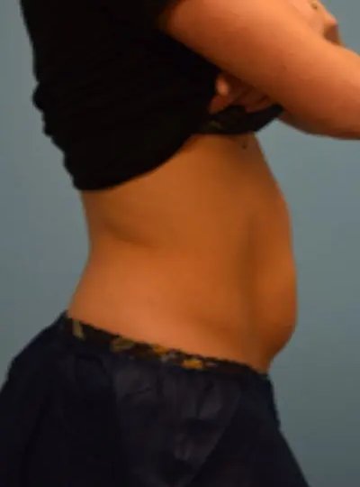 Avant cryolipolyse abdomen Activ Ice
