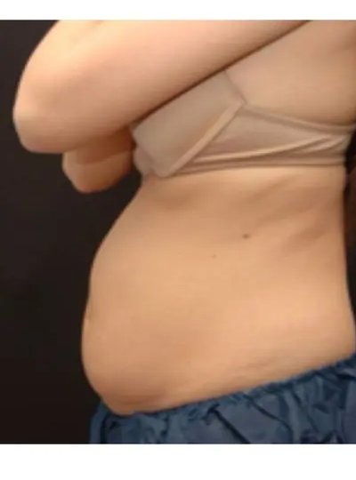Avant cryolipolyse abdomen Activ Ice
