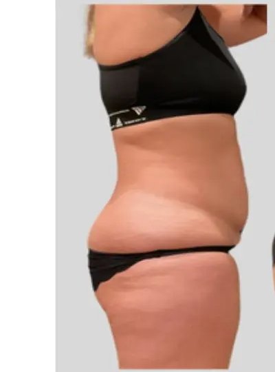 Cryolipolyse abdomen avant Activ Ice