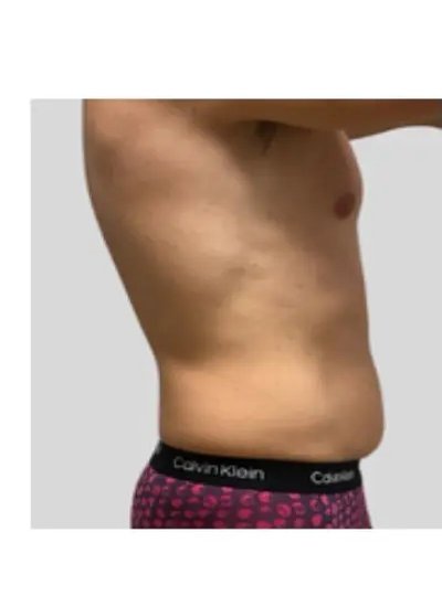 Cryolipolyse abdomen avant Activ Ice