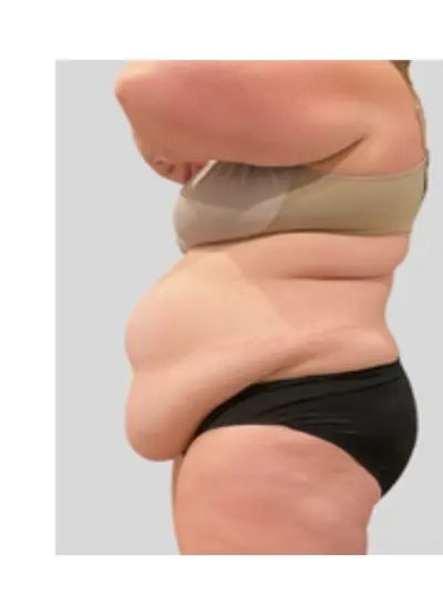 Cryolipolyse abdomen avant Activ Ice
