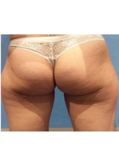 Avant cryolipolyse abdomen Activ Ice