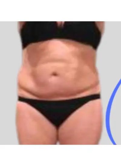 Cryolipolyse cuisses-fesses avant Activ Ice